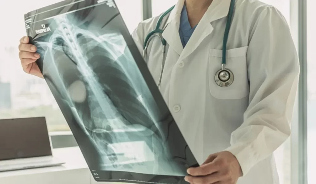 Lung Cancer